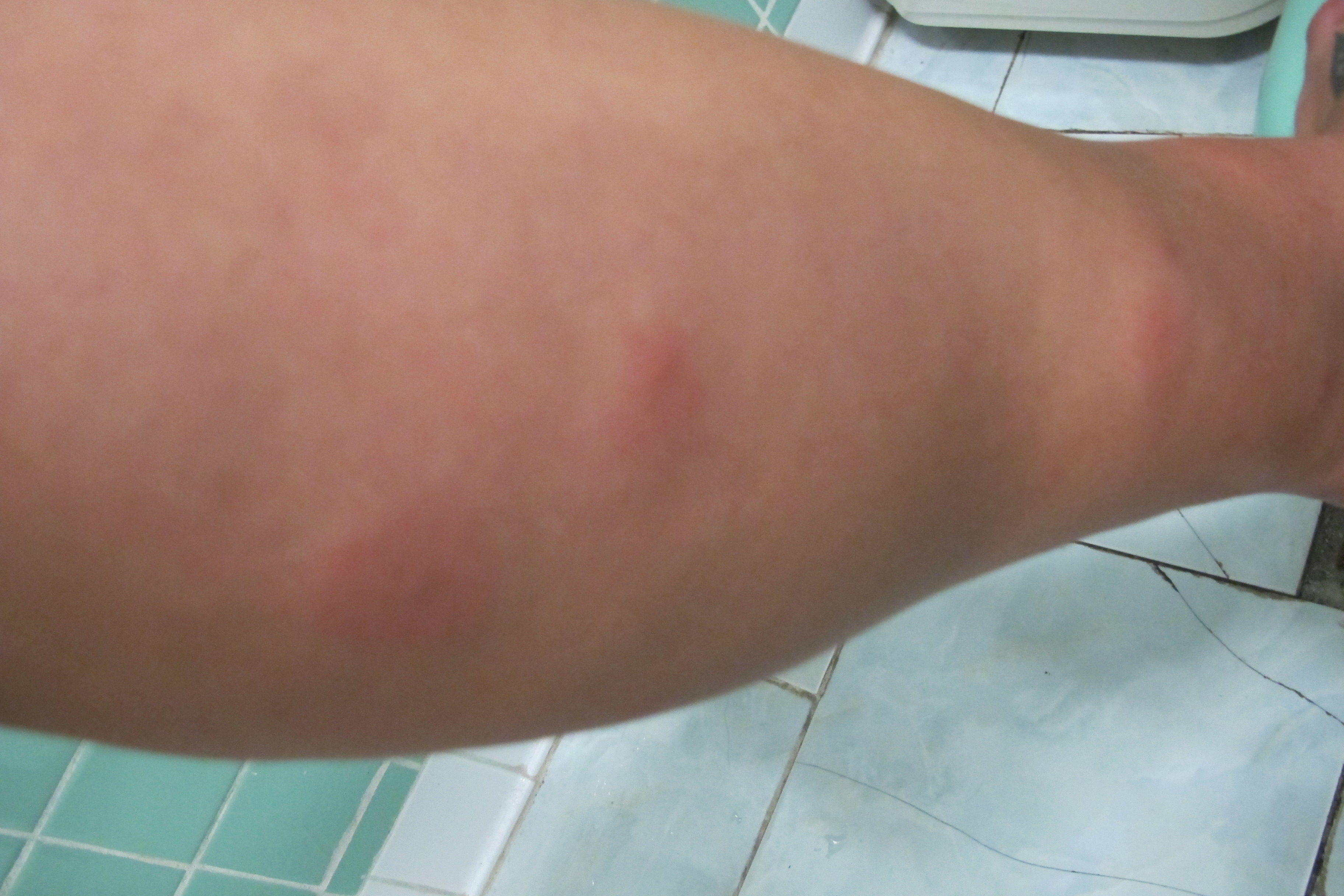 Allergic Mosquito Bites Welts Images & Pictures - Becuo